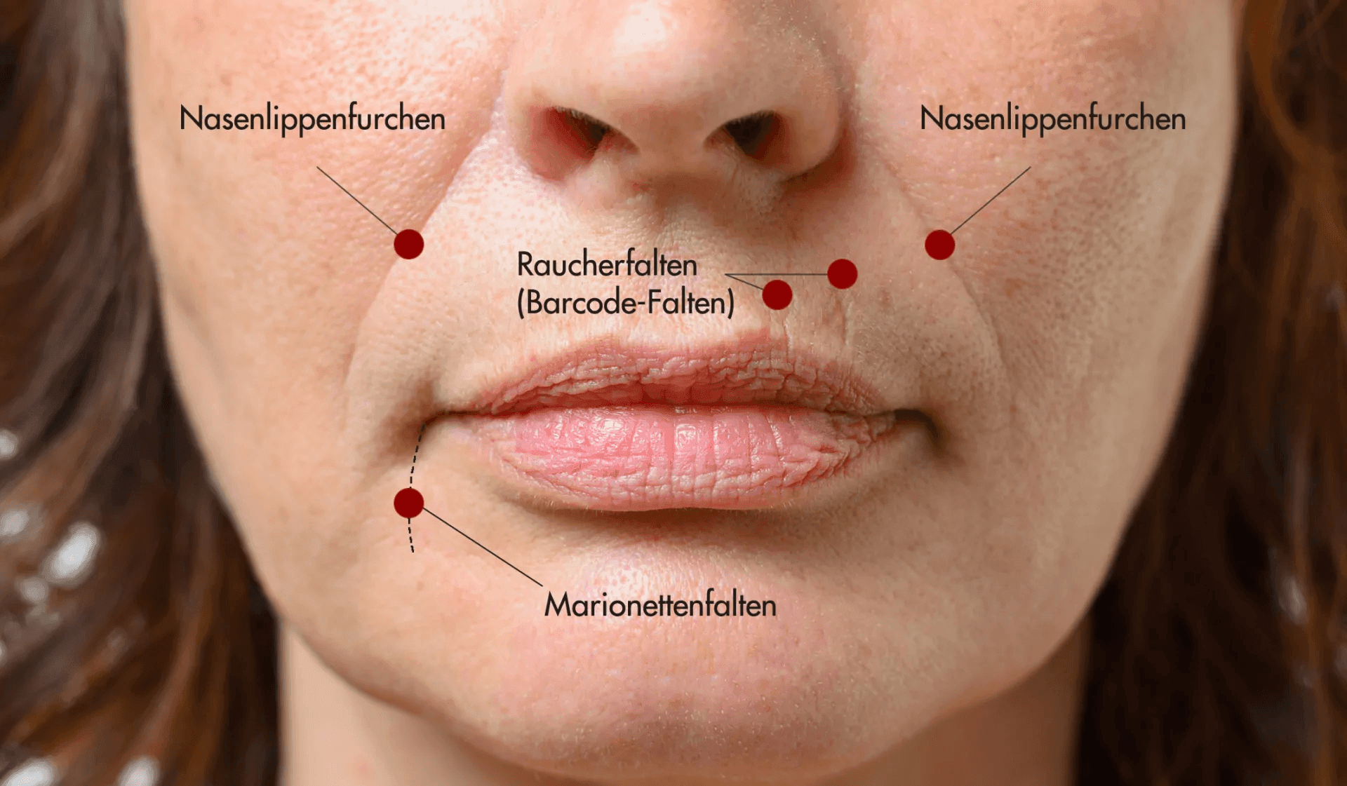 Marionettenfalten Hyaluron